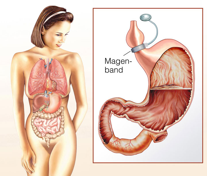 Magenband - Gastric Band